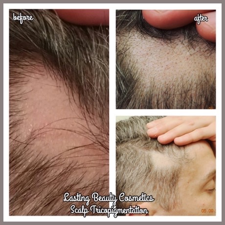 Scalp Pigmentation by Lasting Beauty Cosmetics